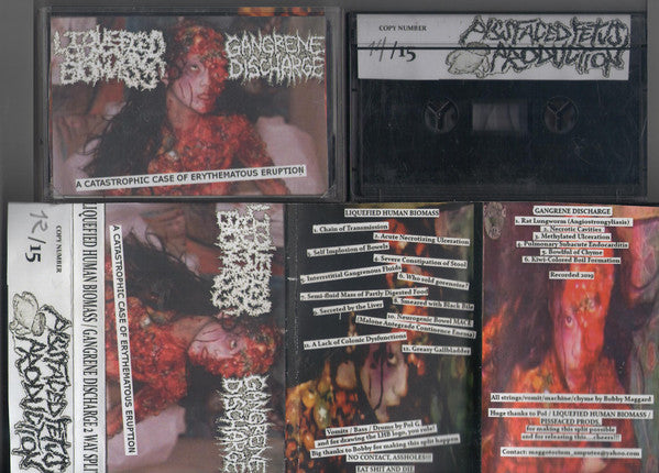 Liquefied Human Biomass / Gangrene Discharge : A Catastrophic Case Of Erythematous Eruption (Limited Edition,Numbered)